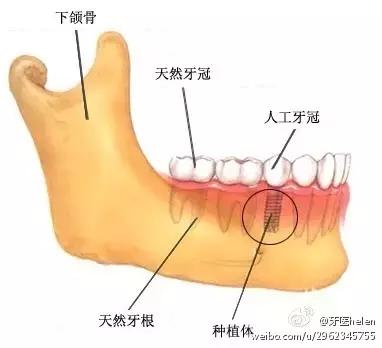 Helen齿科中心——导致种植牙失败的原因有哪些？