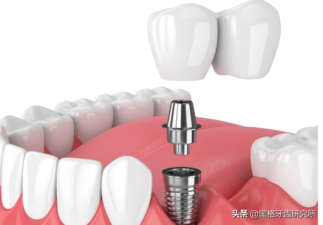 种植牙是缺了几颗就种几颗吗？满口牙掉光，最少只种4颗就能用！