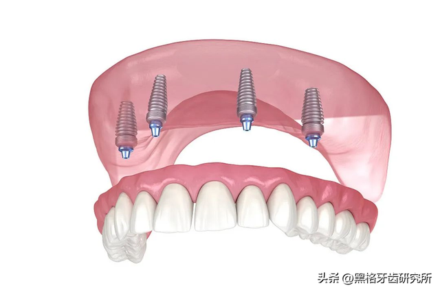 种植牙是缺了几颗就种几颗吗？满口牙掉光，最少只种4颗就能用！