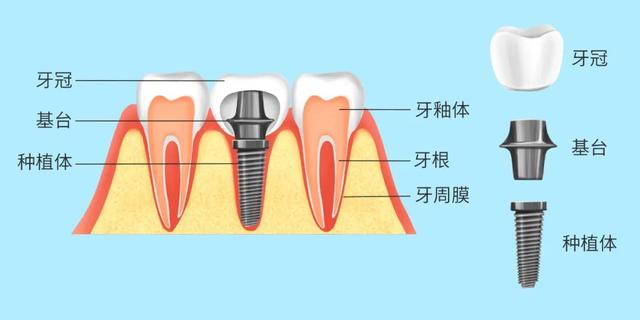 想与种植牙共度余生，这些功课您做了吗？｜老年健康宣传周①