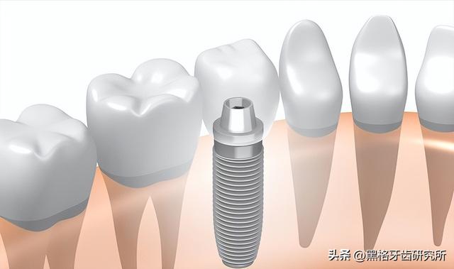 种植牙是缺了几颗就种几颗吗？满口牙掉光，最少只种4颗就能用！