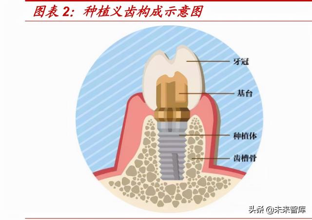 种植牙行业专题报告：千亿市场正启航，看好产业链国产化机遇