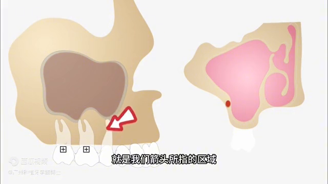 上颌窦内提升植骨演示（一分钟了解）