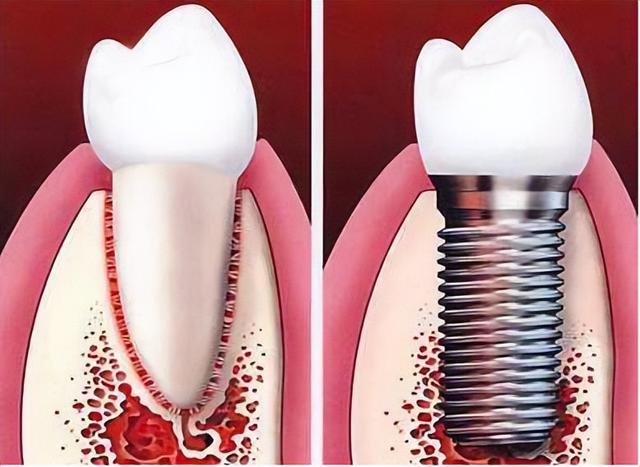 种植牙护理知识分享，科普18个危害与禁忌！
