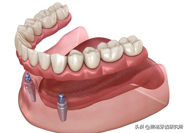种植牙是缺了几颗就种几颗吗？满口牙掉光，最少只种4颗就能用！