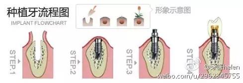 Helen齿科中心——导致种植牙失败的原因有哪些？