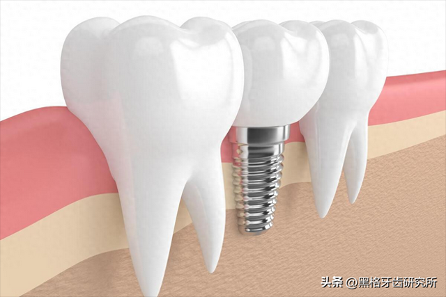 种植牙是缺了几颗就种几颗吗？满口牙掉光，最少只种4颗就能用！