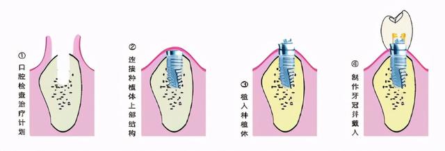 整个种植牙治疗过程需要多久？