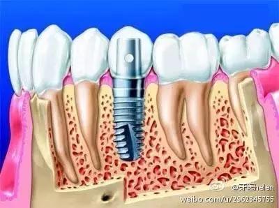 Helen齿科中心——导致种植牙失败的原因有哪些？