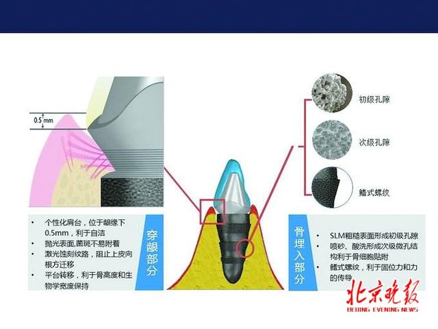 3D打印种植牙要来了！治疗周期缩短治疗费用降低