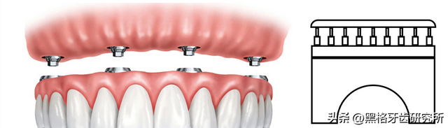 种植牙是缺了几颗就种几颗吗？满口牙掉光，最少只种4颗就能用！