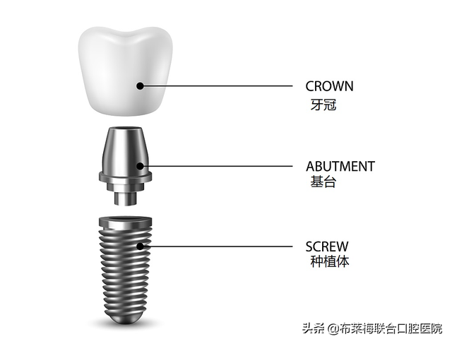 牙齿缺失想种牙，种植牙到底该怎么“种”