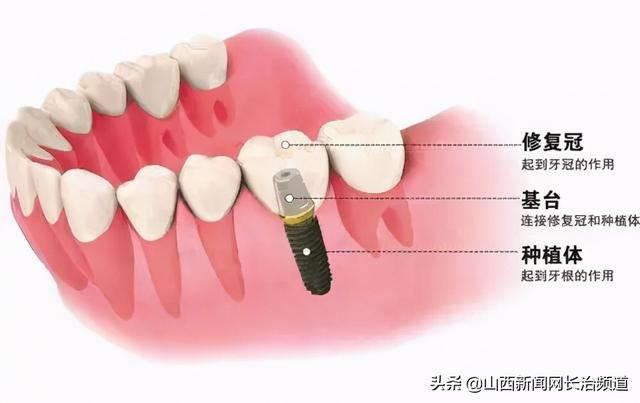 长治市中医研究所附属医院：为什么牙齿缺失后人们更愿意选择种植牙呢？