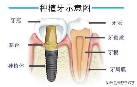 你以为种好牙就完事了吗！还有几种情况会导致种植牙失败呢