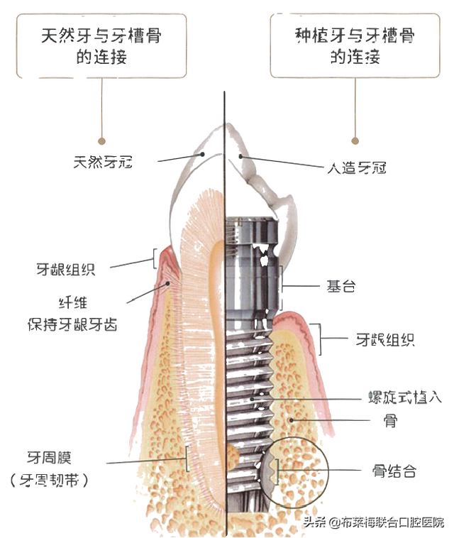 牙齿缺失想种牙，种植牙到底该怎么“种”