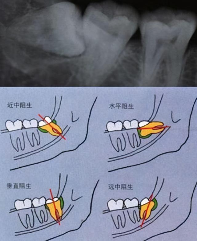 关于拔智齿必须了解这几件事