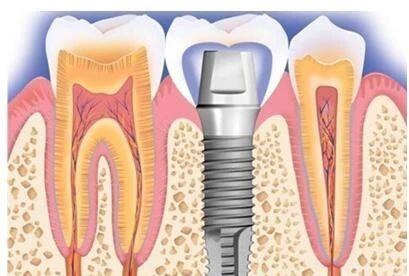 有Q就能种牙？牙医告诉你，这些人不宜做种植牙修复！