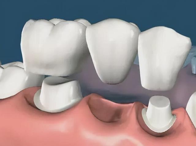 烤瓷冠这样戴基牙都烂掉了！老牙医教你4个轻松应对的方法
