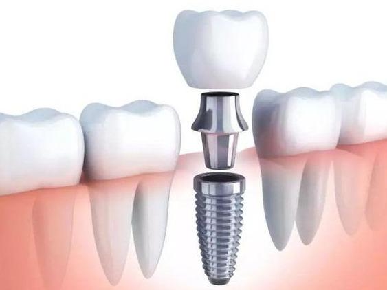 详解种植牙全过程，带你了解种植牙