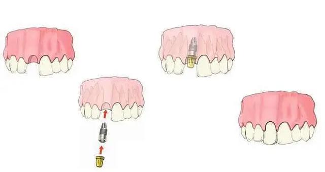 什么情况下适合做种植牙？种牙分为那几期？