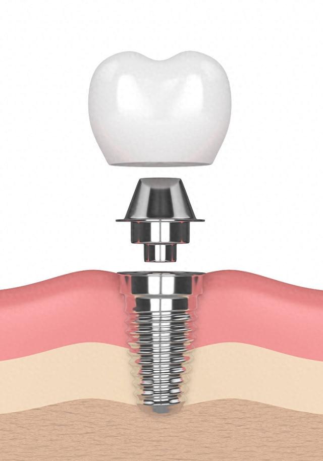 种植牙是怎么种植的？