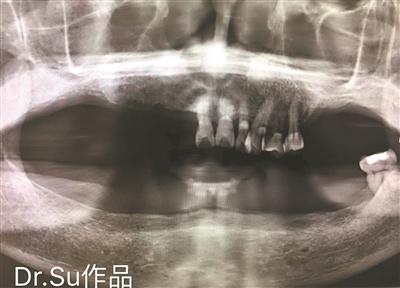 73岁阿叔12颗植体恢复全口牙，高龄缺牙微创无痛轻松种