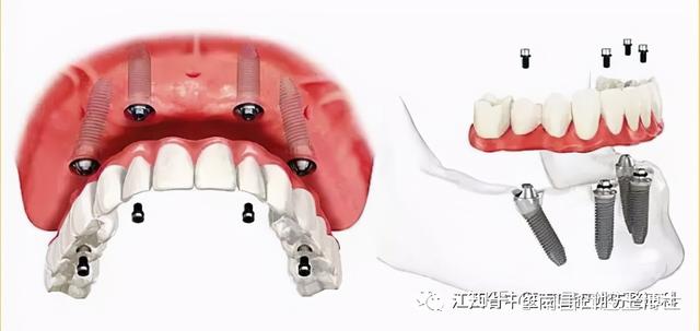 4颗植体，就能种出半口牙