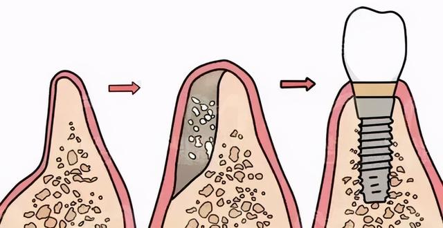 种牙如种树，种树填土，种牙植骨？这个“骨”又是什么？