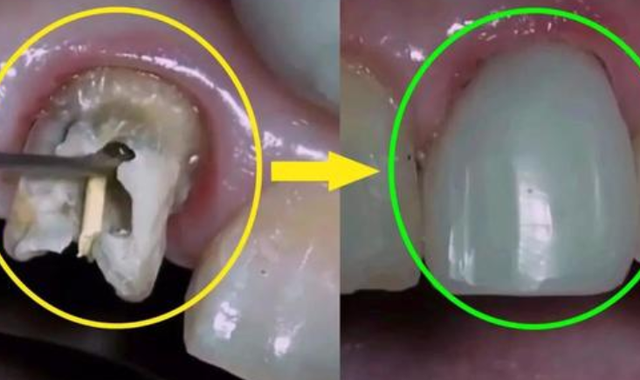 怎么判断蛀牙是否烂到牙神经了？烂到神经还能补牙吗？