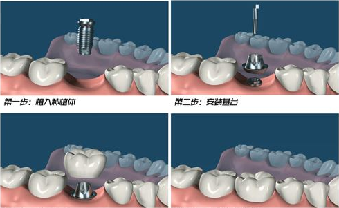 都在问现在的种植牙技术成熟吗？看看就知道