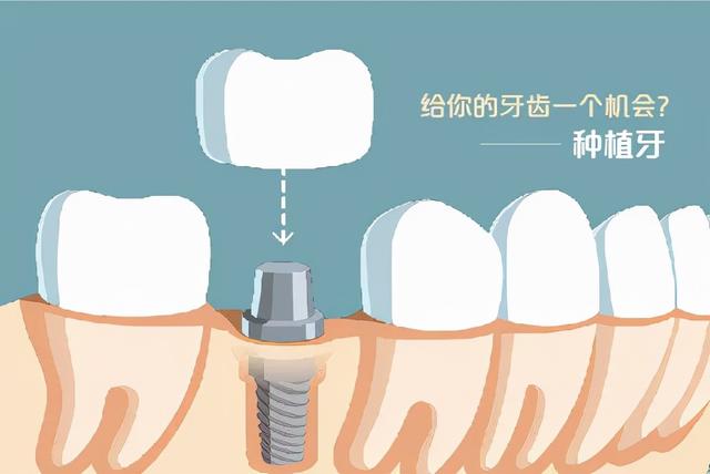 什么情况下适合做种植牙？种牙分为那几期？