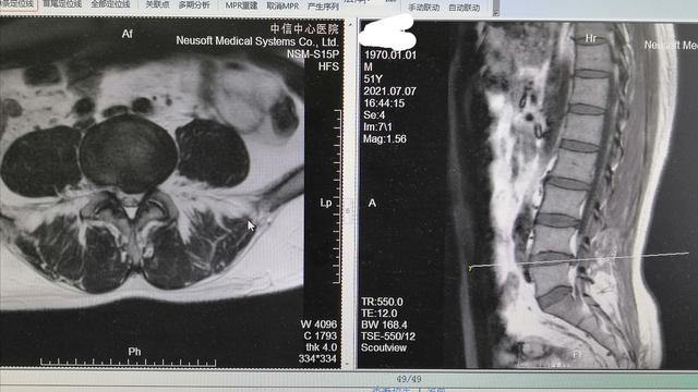 脊柱内镜微创手术治疗腰椎间盘突出症（附带高清镜下视频）