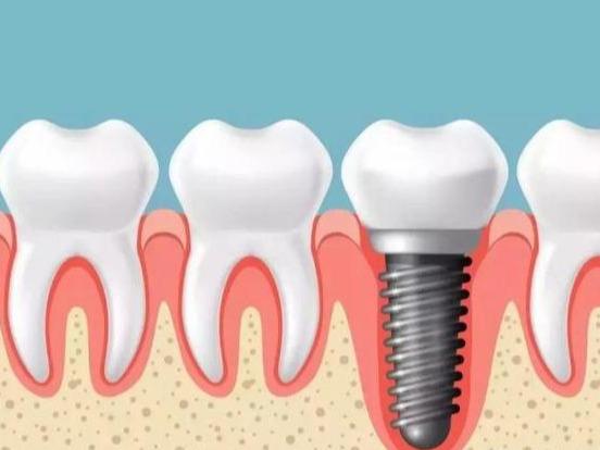 详解种植牙全过程，带你了解种植牙