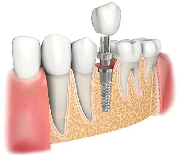 种牙如种树，种树填土，种牙植骨？这个“骨”又是什么？