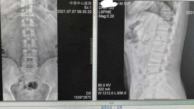 脊柱内镜微创手术治疗腰椎间盘突出症（附带高清镜下视频）