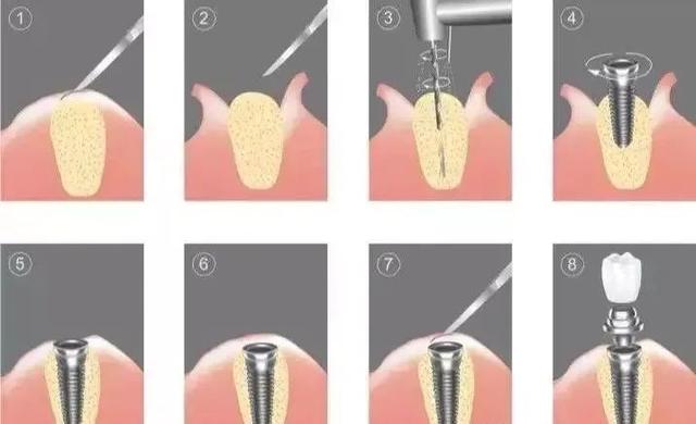 假牙那么多，我为什么选择种植牙？（一篇看懂种植牙）