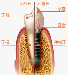 种植牙被“捧上天”了，就没有缺点吗？别问，问就是有