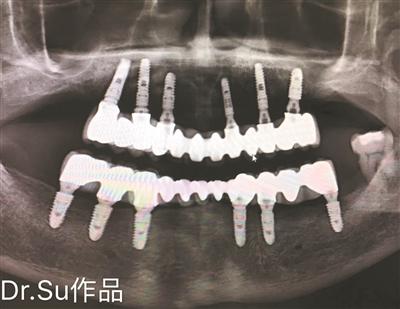 73岁阿叔12颗植体恢复全口牙，高龄缺牙微创无痛轻松种