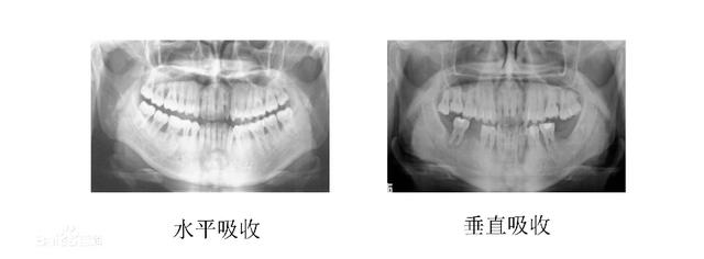 什么是牙槽骨吸收？牙骨消失牙根裸露麻烦大，及时止