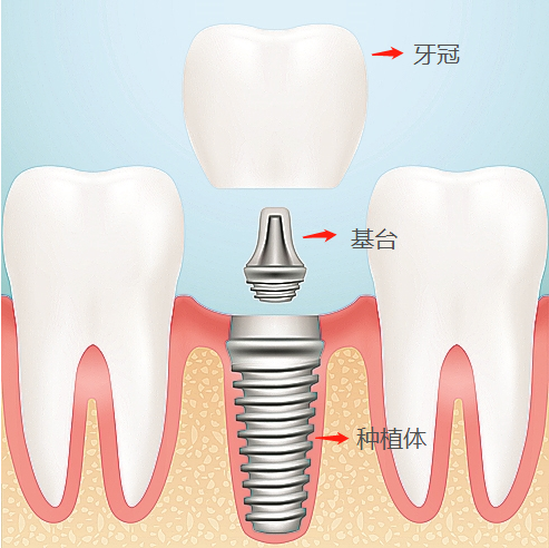 关于佛山种植牙最常见的问题解答（上篇）