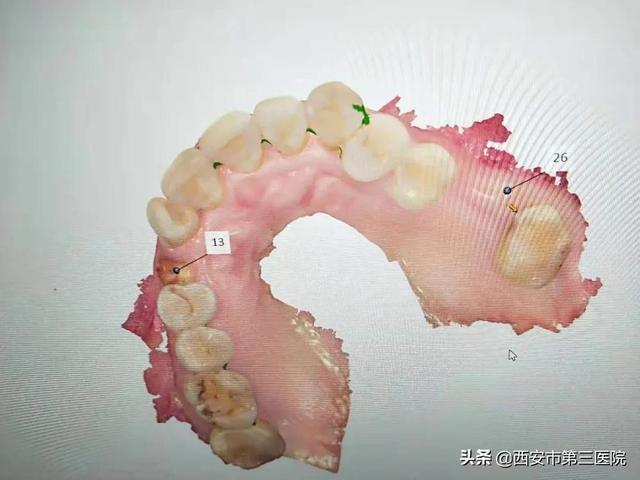 【关注口腔健康】数字化种植牙