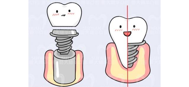 都说种植牙媲美真牙，那你知道它们之间有什么区别吗？