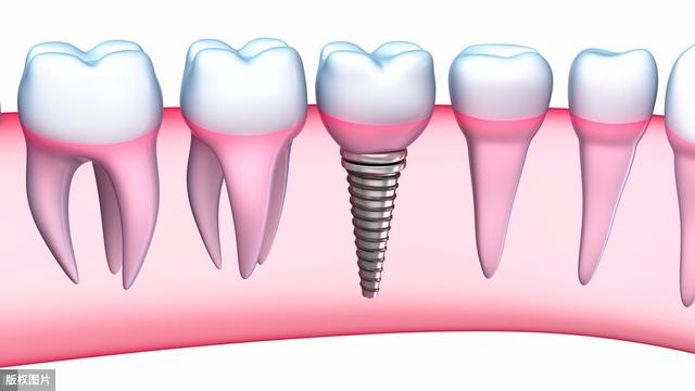 种植牙和烤瓷牙的七大区别