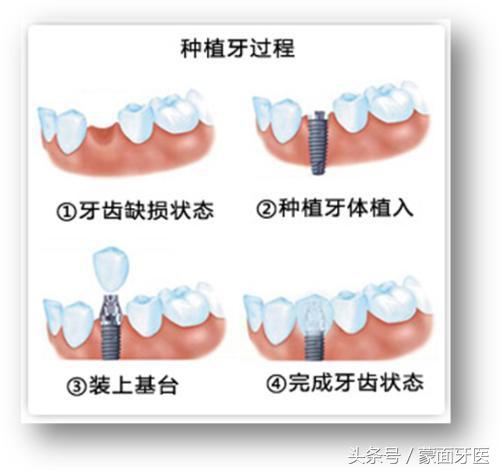 医生，我缺牙了，种植牙、固定牙、隐形牙，我选哪个？