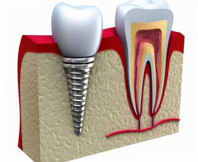 五花八门、价格悬殊的种植牙，水到底有多深？市民该如何选择？
