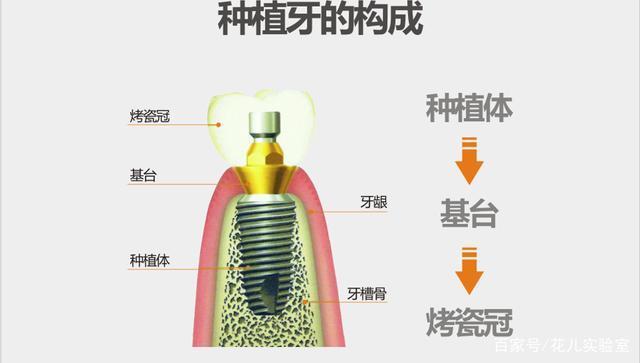 种口牙等于买辆宝马，种植牙到底贵在哪里？