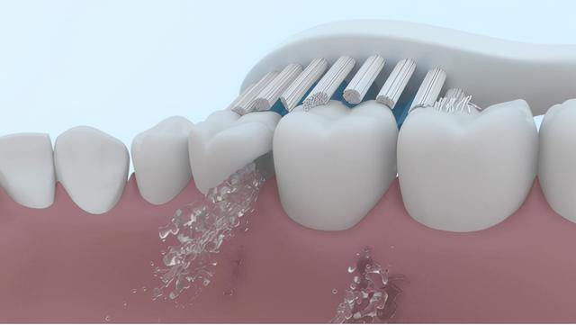 种植牙能用电动牙刷吗？口腔博主警示三大弊端