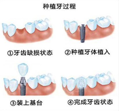 关于佛山种植牙最常见的问题解答（上篇）