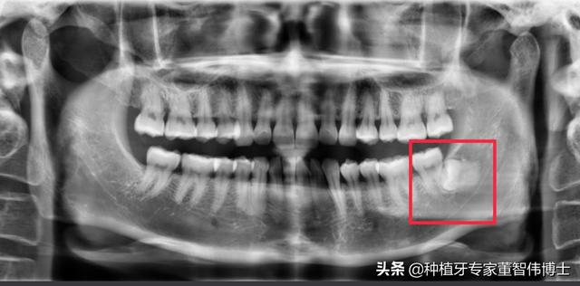 阻生智齿不拔，长期危害大！