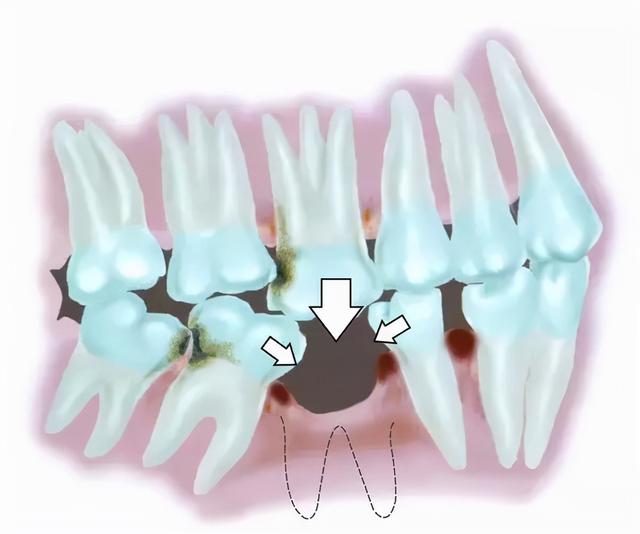 「牙齿那些事儿」No.26丨种了牙之后特别容易塞牙，怎么办？